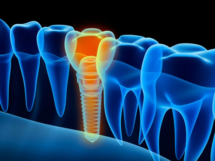 graphic of a yellow screw instead of a blue outlined tooth in an xray