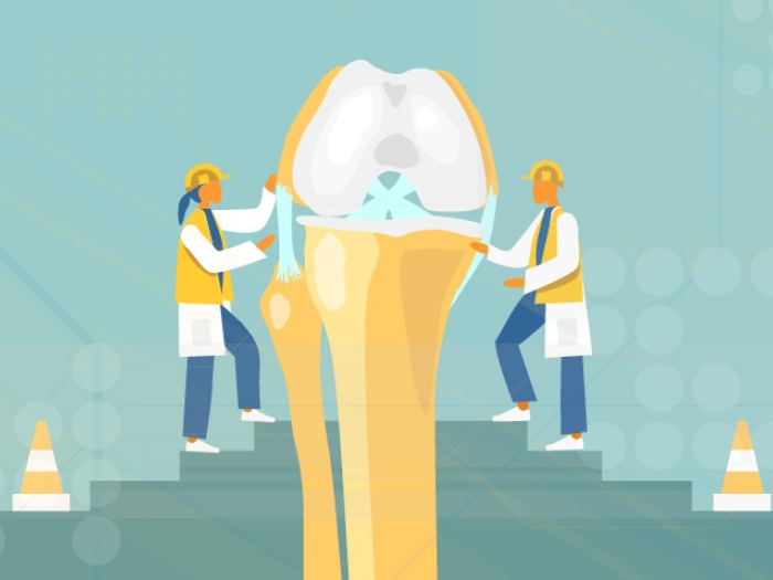 Knee replacement 