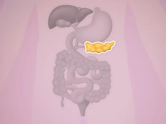 Graphic showing potential pancreatic cancer