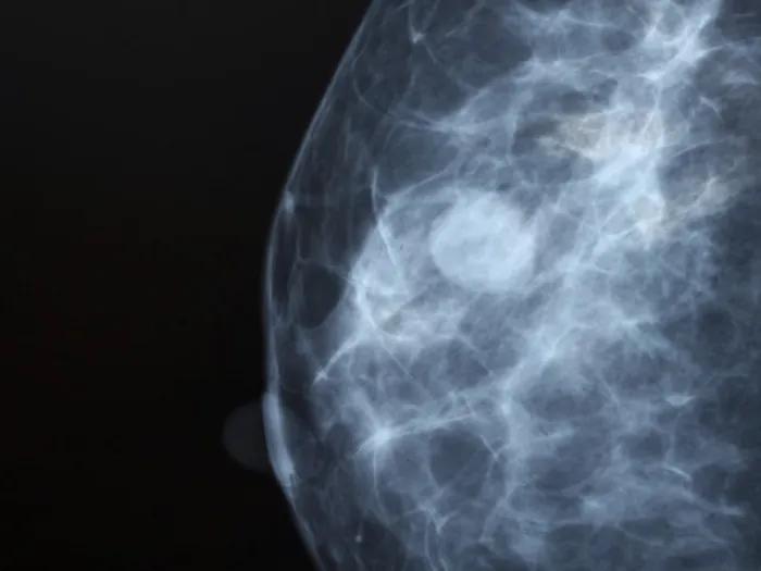 Ultrasound of dense breast tissue