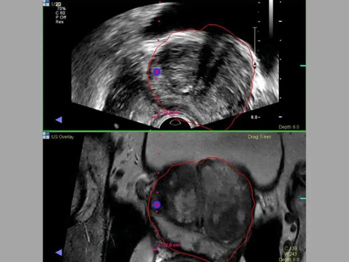 Prostate Cancer Biopsy