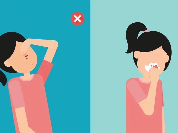 To stop a bloody nose, lean forward, not backward.