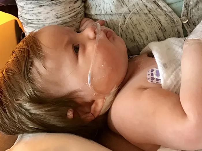 Four month old Nina after open heart surgery to treat tetralogy of fallot