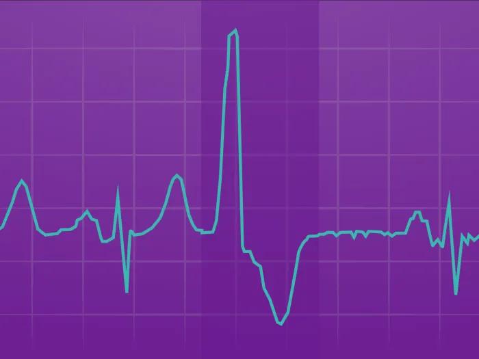 Illustration of an EKG printout showing premature ventricular contractions