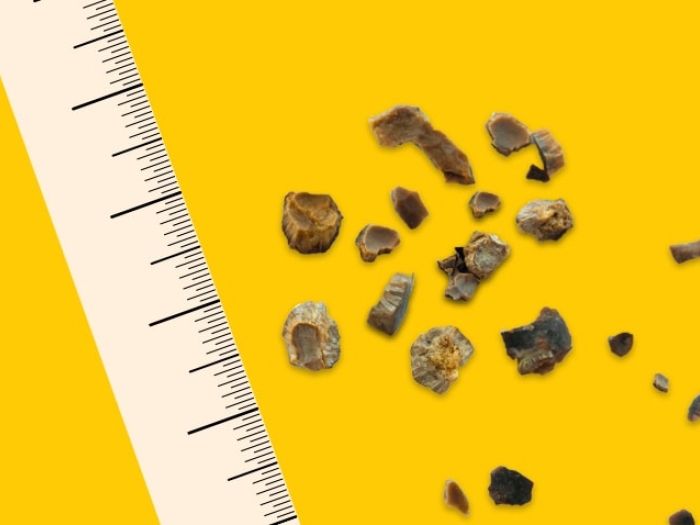 A collection of large kidney stones