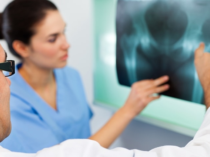 Doctors looking at an x-ray of postmenopausal bone loss