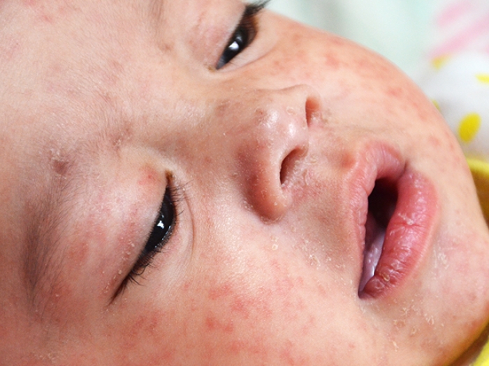 Small child with measles