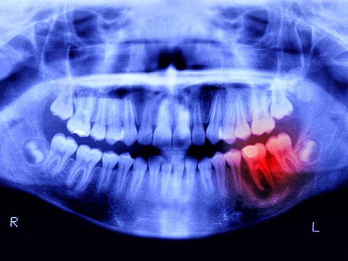 dental xray with red spot noting infection