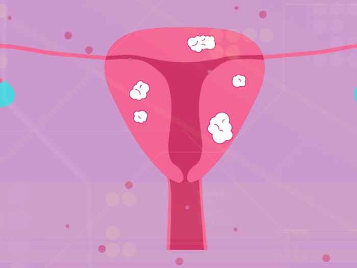 drawing of pink uterus with white fibroid spots on a light purple background