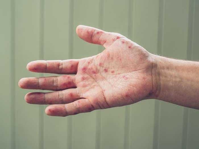 Right hand with blisters from hand, foot, and mouth disease