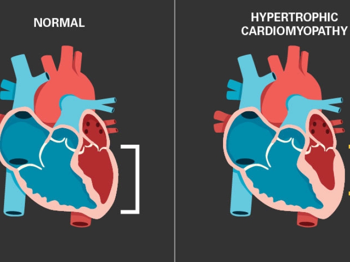 hypertrophic cardiomyopathy and normal heart image in blue and red