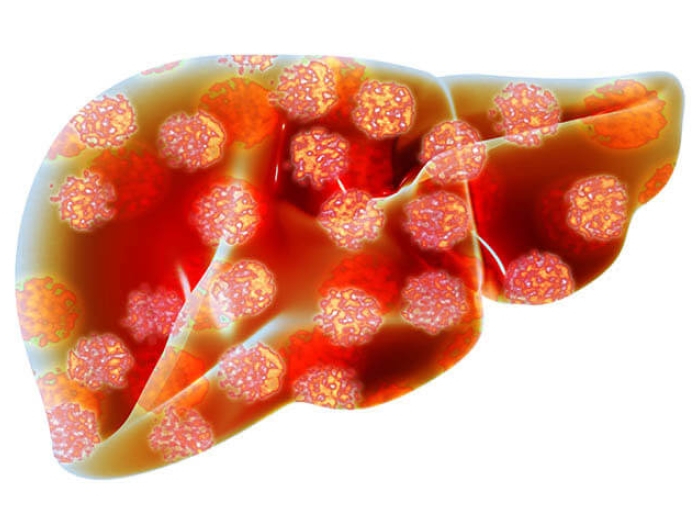 Liver with hepatitis viruses