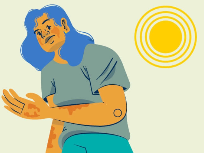 Person standing in the sun in blue with skin rash