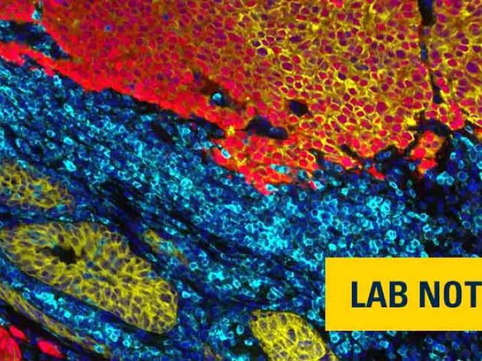 prostate cancer cells in blue green and orange in a microscope view with badge on bottom right saying lab note in yellow and navy blue