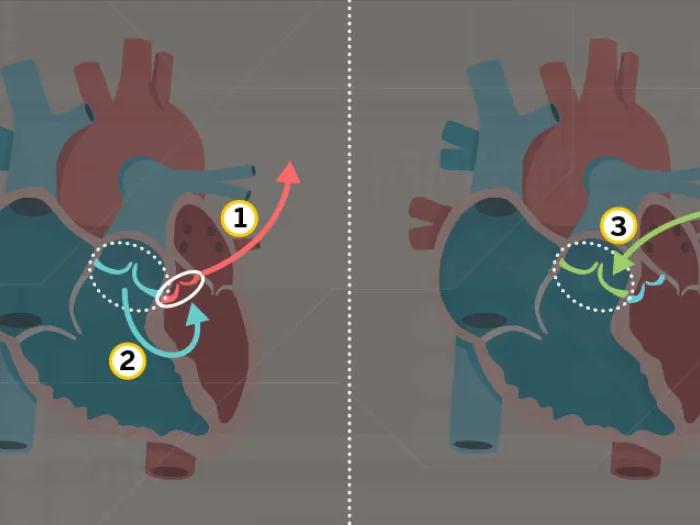 Diagram of the Ross procedure for aortic valve replacement