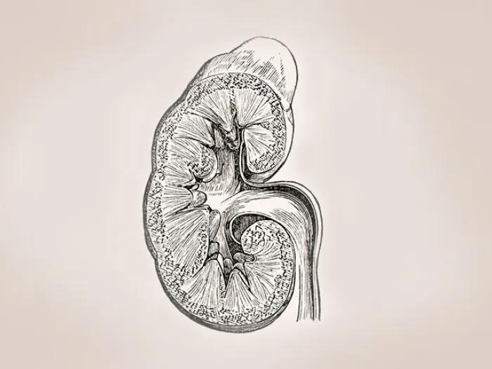 Illustration of a a kidney with lupus nephritis