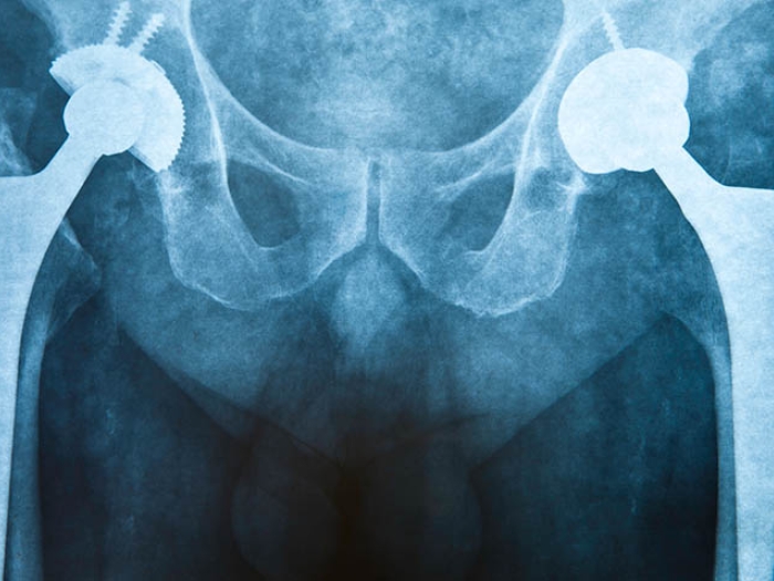 x-ray of hips