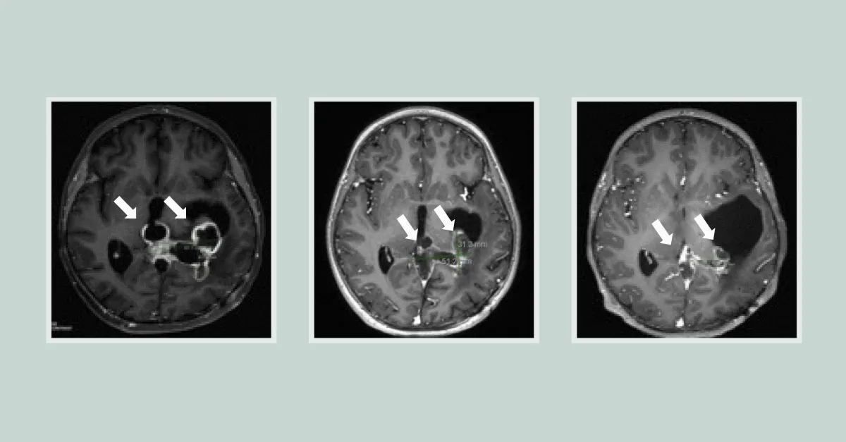 Study finds improved survival for incurable brain tumor, providing