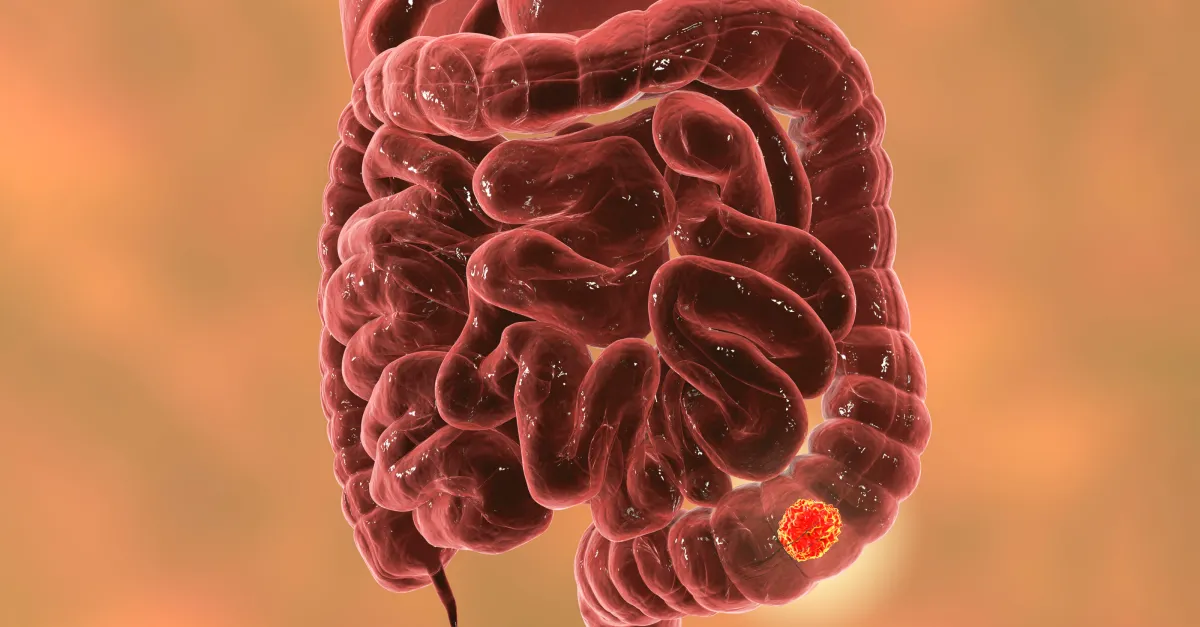 Colorectal cancer is no longer just a disease of older adults