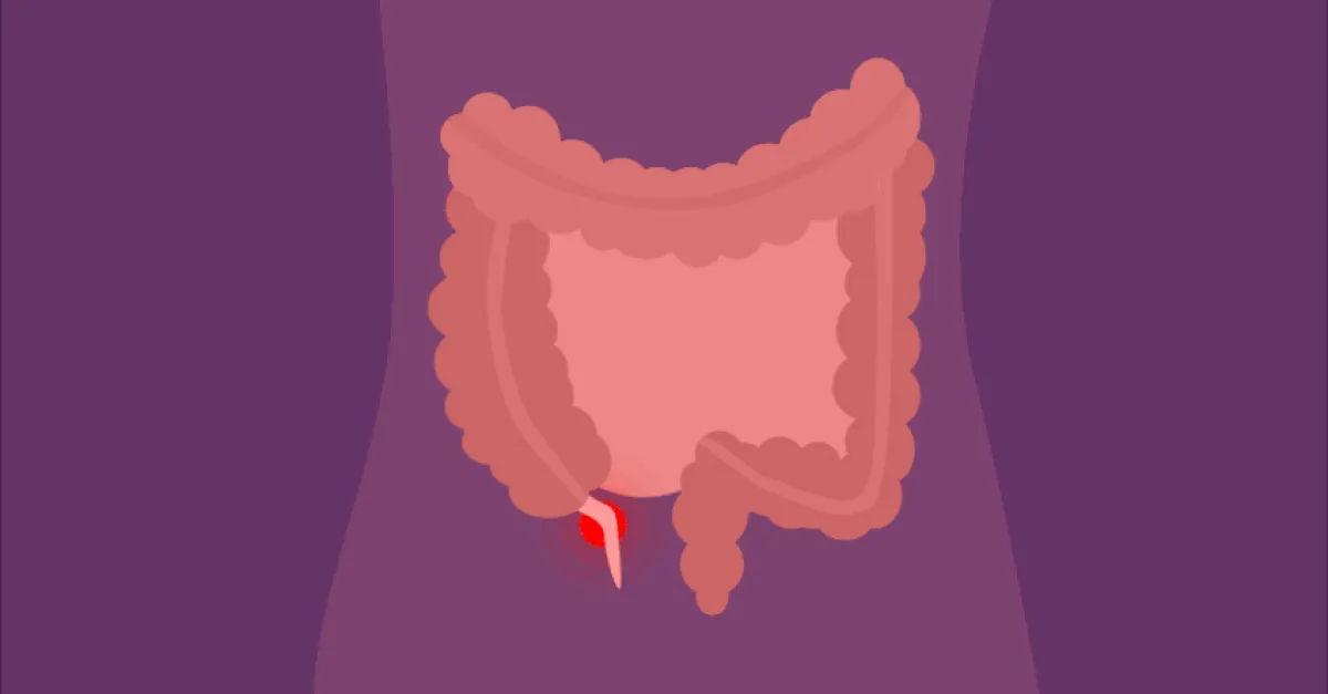 appendicitis glp-1 tirzepatide Appendicitis Why is Appendicitis Not Always