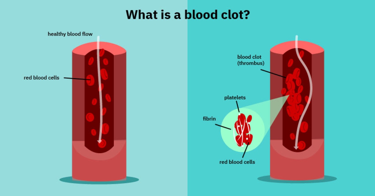Blood Clots: 10 Things to Know
