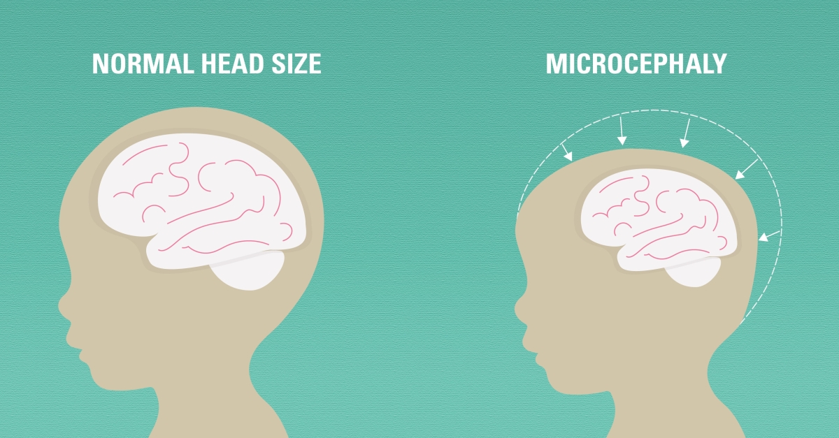 Microcephaly Normal Development Research on Non-Zika Cases of the Birth Defect Microcephaly