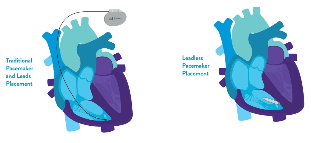 graphic of pacemaker types in heart