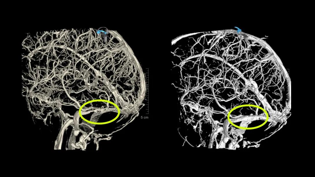 brain scans back to back with yellow circle over certain area