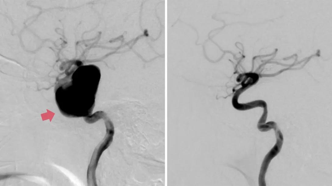 black and white images next to each other of aneurysms one side not fixed and not fixed on left