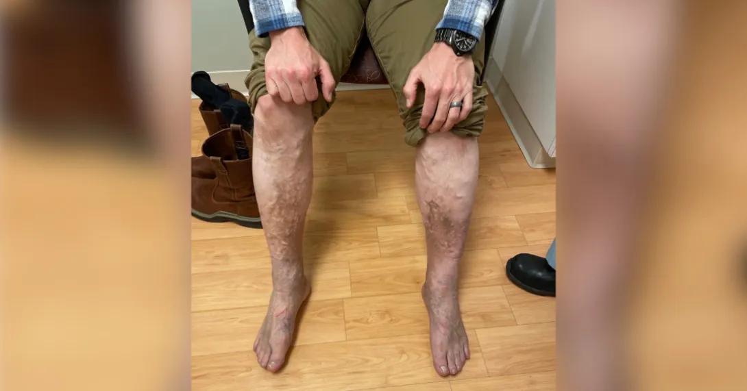 A person has their hands on their knees and shows their swollen legs on a wood floor